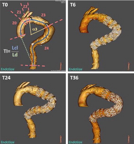 Figure 1. Illustrative aorta at 4 times of follow-up. For T0, centerline (blue) is drawn, zones and some geometric parameters are shown.