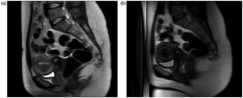 Figure 3. MRI scan of the lower abdomen and pelvis. (A) MR-HIFU qualification MRI scan. (B) MRI scan after the MR-HIFU procedure – visible tumor necrosis.