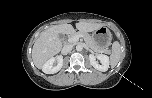 Figure 2 Assessing the tract from the left twelfth rib tip to the left kidney.