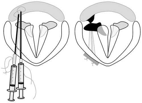 Figure 1. Endoscopic-assisted arytenoid adduction surgery (EAAS). From the cricothyroid ligament toward the piriform sinus, the penetration needle and the loop needle are inserted, and the retracted nylon threads are tightened with a spacer at the cricothyroid ligament. The arytenoid cartilage is successfully adducted. This figure is modified from Murata et al. [Citation7].