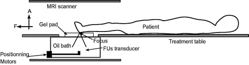 Figure 2. Patient positioning for treatment of osteomyelitis in the foot region using an MRgFUS system. “F” and “A” denote, respectively, foot and anterior directions.