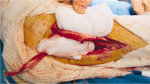 Figure 5. Tibialis posterior tendon debridement after resection of the retro-malleolar bone tunnel. (Right ankle, postero-medial approach, patient in supine position.)