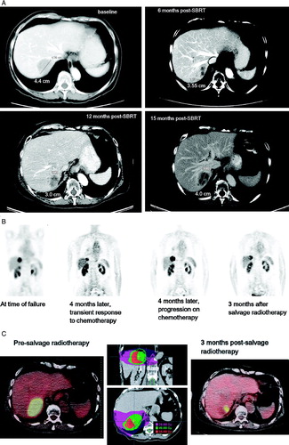 Figure 2.  Analysis of follow-up images for the patient with in-field recurrence. A, diagnostic images obtained, from baseline to 15 months post-SBRT. B, whole body PET scans, from time of failure until after salvage fractionated radiotherapy. C, dose distributions used in the salvage radiotherapy regimen, alongside fused image of CT-PET obtained before (left) and 3 months after (right) salvage radiotherapy. Note that the PET scan change appears to reflect a dose-response, with less activity inside the lateral aspect of the tumor volume that received higher dose.