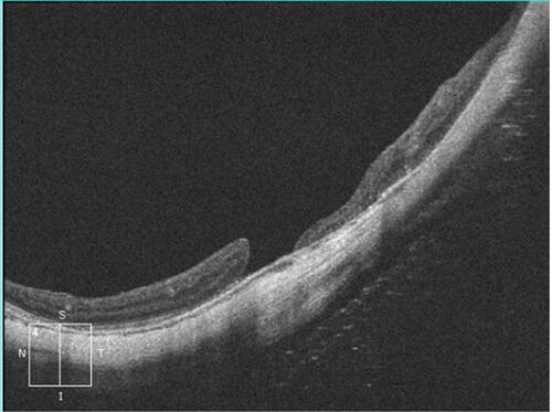 Figure 4 Post-operative SD-OCT image in a 5-line raster scan mode of the left macula of a 75-year old female patient. The patient presented with retinal detachment and macular hole. The axial length of the left eye measured 30 mm. Post-operatively she had retinal re-attachment and open-flat hole configuration (W-type). Note the characteristic steep concavity due to posterior bowing of the globe and significant thinning of the choriocapillaris, which are consistent with high myopia. Her final BCVA was 0.05 decimal units.