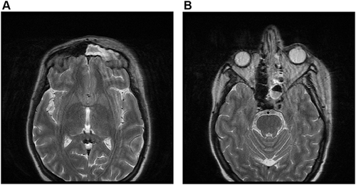 Figure 1 MRI with orbital view showed multifocal infarction (A). MRI with orbital view showed left paranasal sinus extensive mucosal disease (B).