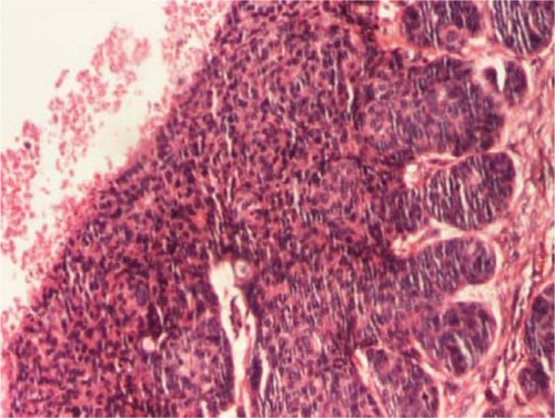 Figure 5 Islands of basaloid cells with palisading disposition in the upper dermis, with contraction around them (hematoxylin and eosin, 40×).