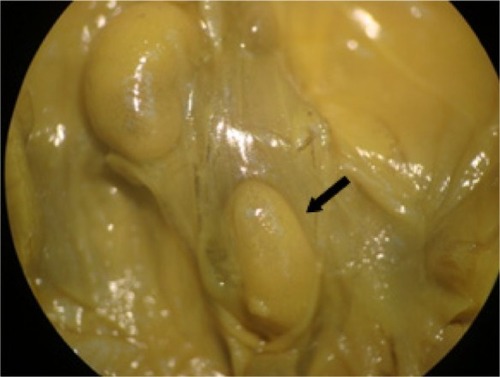 Figure 6 Visceral alteration in the fetus from a rat treated with ZnOSM20(−) NPs (100 mg/kg).Note: Ectopic kidney (malpositioned; arrow).Abbreviations: ZnOSM20(−), 20 nm negatively-charged ZnO; NPs, nanoparticles.