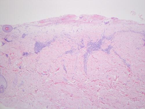 Figure 3 The epidermis is missing. Edema and collagen homogenization is present in papillary dermis. Perivascular inflammatory infiltration is visible. (hematoxylin-eosin staining, original magnification ×40); (subfigure: hematoxylin-eosin staining, original magnification ×100).