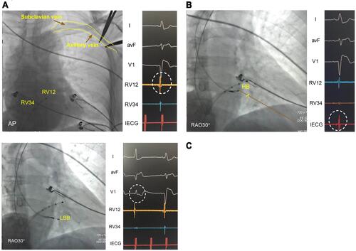 Figure 1 The implantation procedure of LBBaP. (A) Fluoroscopic image of 4-pole RV electrode and axillary vein position, RBB potential were recorded (white circle shows). (B) HB potential (white circle shows) was identified at IEGM and fluoroscopic image of the 3830 lead and sheath position were recorded as a mark. (C) PVC (white circle shows) emerging from endometrial surface of the left ventricular septum was observed during the lead implantation and fluoroscopic image of LBB area was confirmed.