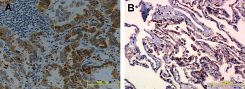 Figure 1 Expression of CHPF in non-small-cell lung cancer tissue (A) and adjacent tissue (B) ×200.