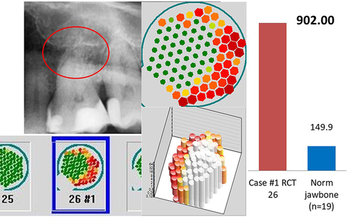 Figure 6 Left window: OPG of area 26 with overview of TAU measurement under radiograph. Middle window: Enlarged single image of the TAU measurement at 26, above in two-dimensional and below in three-dimensional imaging, showing hard root portions of tooth 26 in green with surrounding reduced bone density in red, indicating osteodestruction. Right window: Result of the multiplex measurement of the radicular AP sample with an R/C expression of 902 pg/mL (red column) compared to the R/C expression of 149.9 pg/mL in healthy jaw bone (blue column). Figure Indicators: Red circles mark inflammatory areas of alveolar bone.