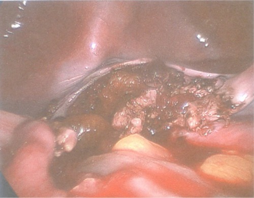 Figure 2 The operation field after laparoscopic irrigation/suction. Note the absence of specific bleeding points.