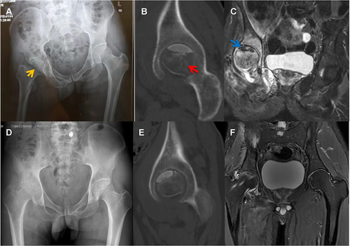 Figure 3 (A) X-ray of the Hip joint showed low signal on the right femoral head (yellow arrow), joint narrowing and even invagination of the joint space. (B) CT showed cavities necrosis and low-density patches of shadows (red arrow) in the right femoral head. (C) MRI showed effusion of the right Hip joint and necrosis of the right femoral head (blue arrow), and the inflammatory fluid diffused with extra-articular. (D–F) X-ray, CT and MRI of the osteonecrosis area four years later are better.