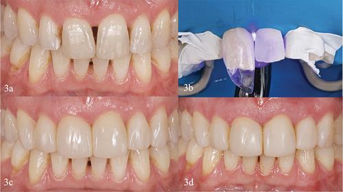 Figure 3. Clinical case II. (a) Initial intraoral front view. (b) It was performed a back triangles closure from canine to canine. Anterior HD an DC diastema closure upper mesial-distal. Bioclear matrix systems. Bioclear was used. (c) Two weeks review. (d) Two years review, highlighting gingivitis due to plaque accumulation and loss of polish because the patient never returned to maintenance.