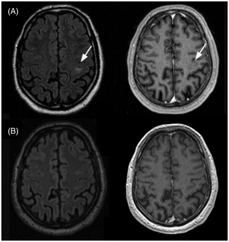 Figure 9. Neurosarcoidosis treatment response to prednisone. A: MRI of a 57-year-old patient with probable neurosarcoidosis. The singular FLAIR hyperintense, contrast-enhancing CNS lesion on T1-weighted images (arrows) is completely remittent after oral prednisone therapy (B). Courtesy of Dr S. Sartoretti, Winterthur.