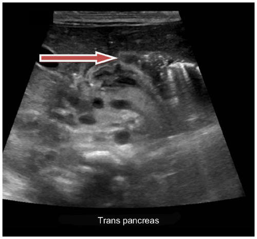 Figure 1 Abdominal ultrasound showing type I choledochal cyst.