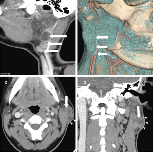 Figure 1 The multiple tuberculous lesions of right parotid nodes are linearly arranged on sagittal CT image.