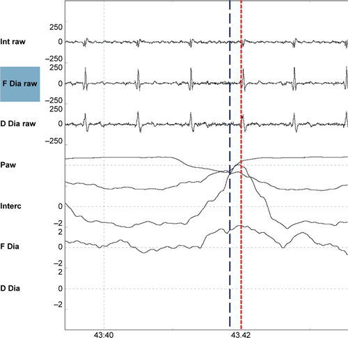 Figure S7 Premature cycling.Notes: Shown are (from top to bottom) the raw intercostal signal (Int raw), the raw frontal diaphragm signal (F Dia raw), the raw dorsal diaphragm signal (D Dia raw), the pressure wave (Paw), the average intercostal signal (Interc), the average frontal diaphragm (F Dia) signal, and the average dorsal diaphragm signal (D Dia). Electromyography activity (the maximum of the electromyography is depicted by the red dotted line) continues, while the pressure returns to baseline again (the end of the inspiratory pressure delivering is depicted by the blue dotted line).