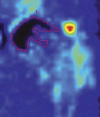 Figure 1. F-PET scan of a resurfaced hip. Low tracer uptake by prosthetic components, cement, and bone. The dotted red line indicates area of low uptake (< 0.65 SUV), which appears black.