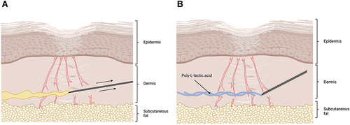 Figure 5 Subcision Combined With Injectable Treatments.