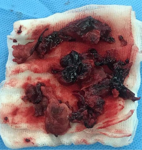 Figure 4 Thrombuses removed from the left and right pulmonary arteries at the time of surgery.