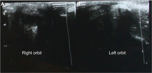 Figure 2 Ocular ultrasound of a newborn affected by (A) severe right-side microphthalmia with the presence of a vesicle in the right-side cavity, and (B) left-side anophthalmia with an empty orbital cavity.