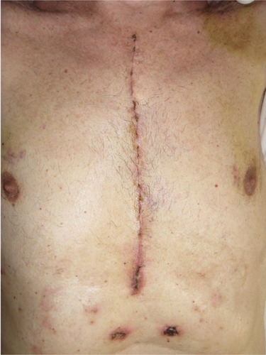 Figure 3 Intervention of sternotomy after cardiac surgery. There is a high percentage of risk that the scar could develop into a pathological scar.