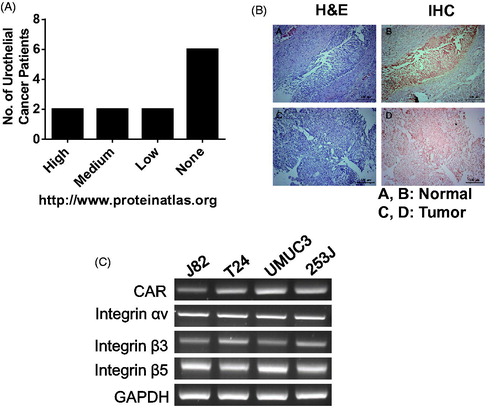 Figure 1. Downregulation of CAR proteins in bladder cancer. (A) CAR expression in bladder cancer according to a protein atlas (www.proteinatlas.org). (B) Bladder tumors and matched normal urothelium from NMIBC patients were harvested, fixed with 1% formaldehyde and were analyzed with anti-CAR antibodies following the standard protocol. (C) Bladder cancer cells were grown in 100 cm2 dishes and CXADR transcripts were evaluated using RT-PCR, as stated in the Methods.