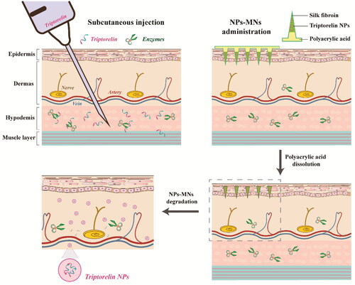 Figure 1. Schematic illustrations of subcutaneous injection and administration of nanoparticles-encapsulated polymeric microneedles (NPs-MNs).
