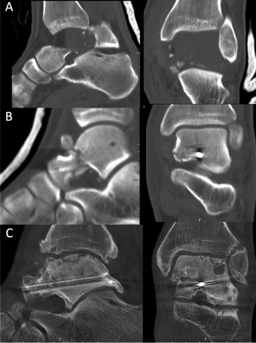 Figure 3. CT of a Hawkins type 3 fracture (A) in a 26-year-old man after a fall from a ladder. The fracture was treated with screw fixation (B), a non-weight-bearing cast for 8 weeks, and alendronate for 6 months. After 12.5 years, the fracture appeared to be healed on CT, showing post-traumatic talocrural OA and partial collapse of the talar dome (C).