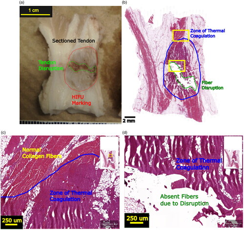 Figure 11. (a) Gross anatomy is a ruptured tendon with an area of tendon rupture. (b) Histology of ruptured tendon with fiber disruption in the zone of thermal coagulation. (c) Magnification in the border between normal collagen fiber and zone of thermal coagulation. (d) Magnification in border between a zone of thermal coagulation and the absence of collagen fibers due to disruption.