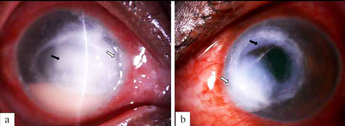 Figure 1 (a) Digital slit-lamp image of the right eye of the patient depicting diffuse conjunctival congestion, 8×8 mm creamy white full-thickness infiltrate (black arrowhead), stromal melt and nasal peripheral furrowing (white arrowhead) with guttering along with 3 mm anterior chamber hypopyon (severe ulcer). (b) Digital slit-lamp image of the right eye of the patient depicting diffuse conjunctival congestion, crescentic eccentric 7×7 mm mid to posterior stromal infiltrate (black arrowhead), inferonasal full-thickness infiltrate, nasal limbal spread (white arrowhead), and central corneal thinning with impending perforation (severe ulcer).