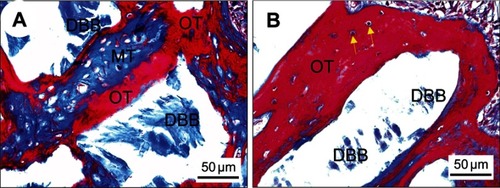 Figure 5 Histological observation of bone restoration after 12 weeks post-implantation. Representative Masson’s trichrome staining images of DBB granules within defects covered with PTFE membranes (A) or BTO/P(VDF-TrFE) nanocomposite membranes (B). Yellow arrows denote viable osteocytes in their lacunae. Scale bar =50 μm.Abbreviations: DBB, deproteinized bovine bone; OT, osteoid tissue (red); MT, mineralized tissue (blue); PTFE, polytetrafluoroethylene; BTO, BaTiO3; P(VDF-TrFE), poly(vinylidene fluoridetrifluoroethylene).