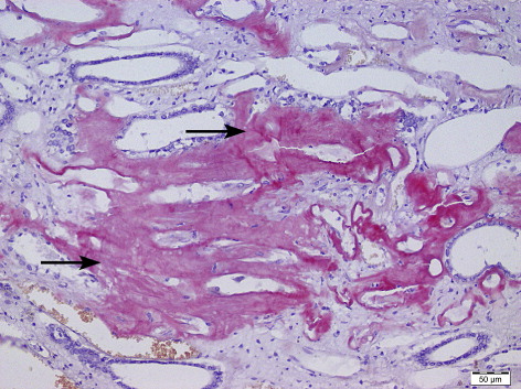 Figure 4. Renal medullar amyloidosis characterized by the accumulation of interstitial congophylic and amorphous deposit.