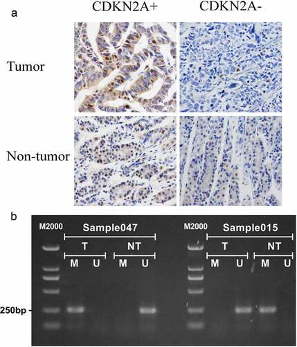 Figure 7. Immunohistochemistry and CDKN2A methylation-specific PCR in GC and adjacent non-tumor tissues. (a) Representative examples of IHC staining for CDKN2A protein expression (Magnification, 400×). (b) Representative examples of methylation analysis of CDKN2A gene promoter. U, unmethylation; M, methylation; T, primary gastric carcinoma tissues; NT, adjacent non-tumor tissues