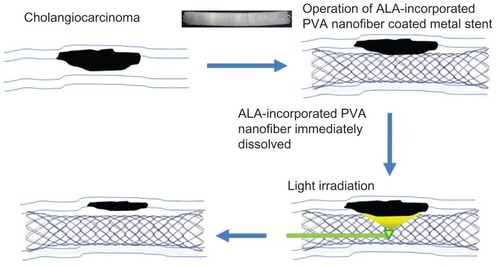 Figure 7 Schematic illustration of combination of stent placement and PDT for cholangiocarcinoma.Abbreviations: PDT, photodynamic therapy; ALA, 5-aminolevulinic acid; PVA, poly(vinyl alcohol).