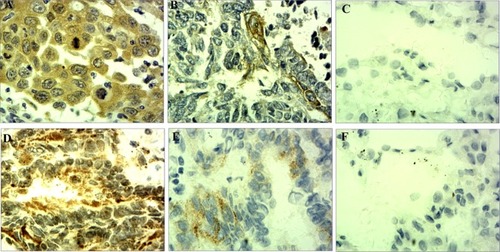 Figure 2 Immunohistochemical staining of lung cancer tissue sections demonstrating KLF6-SV1 (original magnification ×400).Notes: (A) Lung squamous cell carcinoma specimen with high expression of KLF6-SV1. (B) Lung squamous cell carcinoma specimen with low expression of KLF6-SV1. (C) The corresponding normal lung tissue specimen with no KLF6-SV1 expression (contrast). (D) Lung adenocarcinoma specimen with high expression of KLF6-SV1. (E) Lung adenocarcinoma specimen with low expression of KLF6-SV1. (F) The corresponding normal lung tissue specimen with no KLF6-SV1 expression (contrast).Abbreviation: KLF6, Kruppel-like factor 6.