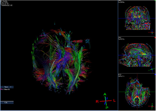 Figure 8 Male (58 years old) with headache, dizziness, and fatigue for seven days. Diffusion tensor imaging showing the white mass fiber bundle in the mass area was significantly interrupted and reduced.