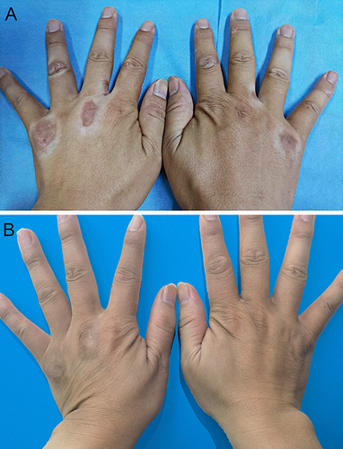 Figure 1 Plaques in extensor interphalangeal joints of both hands before and after treatment. (A) Plaques in extensor interphalangeal joints of both hands before treatment. (B) Two months after treatment.