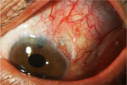 Figure 3 Ahmed glaucoma valve: tube exposure due to conjunctival erosion.