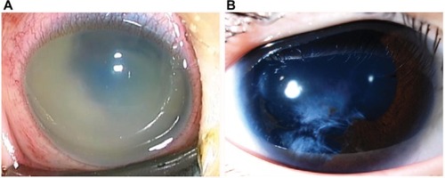 Figure 1 (A) External photograph of the right eye of a 1-year-old girl patient shows a cloudy cornea, hypopyon, and no posterior view on the third day after the initial presentation. (B) External photograph of the right eye 7 years after the treatment with intravenous, topical, and intravitreal antibiotics and vitrectomy shows focal iris atrophy and cortical lens opacities.