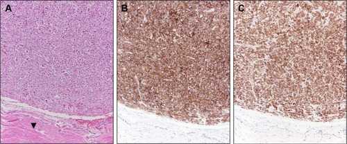 Figure 2 Case 1 GIST surgical resection pathology findings.