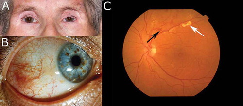 Figure 2. A. Eyelid stiffness, tightness, telangiectasia, madarosis, and blepharitis in the upper and lower eyelids of an SSc patient. B. Conjunctival and episcleral blood vessel congestion in a patient with SSc. C. Microvascular abnormalities (black arrow) and choroid atrophy (white arrow) on the fundus of an SSc patient. Additionally, a macular hole can be observed as an accessory finding, and was presumably not related to SSc