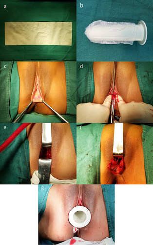 Figure 1 The surgical procedure of vaginal reconstruction for patients with MRKHS using SIS grafts. (a) A piece of swine small intestinal submucosa biological graft. (b) Shape the SIS graft into a cylinder. (c) Make incision at the mucous membrane between the urethra orifice and posterior perineum. (d) Divide the tissue between urethra and rectum to make a neovagina cavity. (e) Expand the neovagina cavity to 10cm in depth and 3 fingers in width. (f) Fix the SIS graft to neovagina cavity. (g) Place mould after operation.