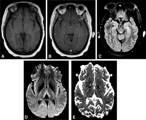 Figure 3 Brain MRI findings in Wernicke encephalopathy. Axial views. (A) Precontrast T1 scan is unremarkable. (B) Postcontrast T1 scan demonstrates enhancement of the mammillary bodies. (C) T2 FLAIR image reveals hyperintensity of the periaqueductal gray. (D) Diffusion-weighted imaging shows hyperintense signal in the medial thalami. (E) ADC map shows mild diffusion restriction, consistent with cytotoxic edema.
