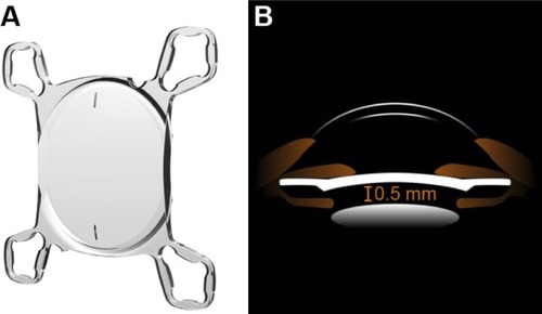 Figure 1 Design (A) and sulcus location (B) of the AddOn® secondary IOL.