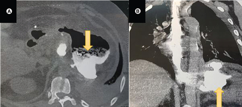 Figure 1. (A) CT scan axial view showing a left subphrenic collection (yellow arrow) communicating with the gastric sleeve.(B) CT scan coronal view showing the left subphrenic collection (yellow arrow).