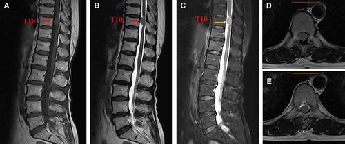 Figure 1  Magnetic resonance images (MRI) of pre-operation. (A–C) Preoperative sagittal MRI showed a sizeable IDEM tumor (red arrow) at the T10 level with an intact envelope and clear borders. (D and E) Preoperative axial MRI showed that the IDEM tumor significantly compressed the thoracic spinal cord to the right side, with 80% intraspinal encroachment. The red and yellow lines represent the axial planes in (C).