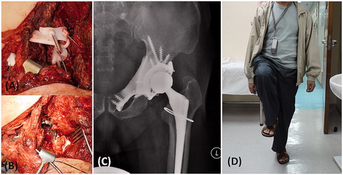 Figure 6. (A) The femoral neurovascular bundles and iliopsoas muscle were protected and retracted medially. The PSI for the acetabular and pubic osteotomies was positioned and secured with K-wires. (B) After PSI-guided tumor resection, the implant was fitted precisely to the bone defect and stabilized with multiple screws fixation as planned. At 10 months after the surgery, the anteroposterior radiograph of the pelvis (C) showed good implant alignment and no evidence of implant loosening. (D) The patient could walk unaided and could achieve single leg standing.