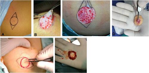 Figure 1 DFG epidermis removal techniques. (A) The donor site is marked (upper outer buttock quadrant). (B) #15 Bard-Parker blade dissection. (C) After complete removal of epidermis (multiple spot hemorrhages and scattered foci of exposed fat). (D) The dermis fat graft following epidermal scalpel dissection. (E) Debridement of the graft epidermis using the bipolar diathermy. (F) The dermis fat graft after electrocoagulation of the epidermis.